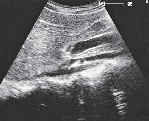 Uncinate process ultrasound image, Head of pancreas, superior mesenteric vein, uncinate process