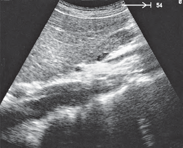 Body of Pancreas Ultrasound Anatomy