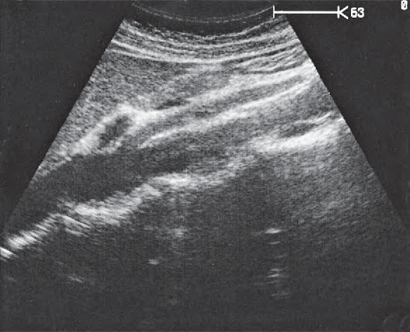Stomach ultrasound image, Body of pancreas, splenic vein, superior mesenteric artery, aorta