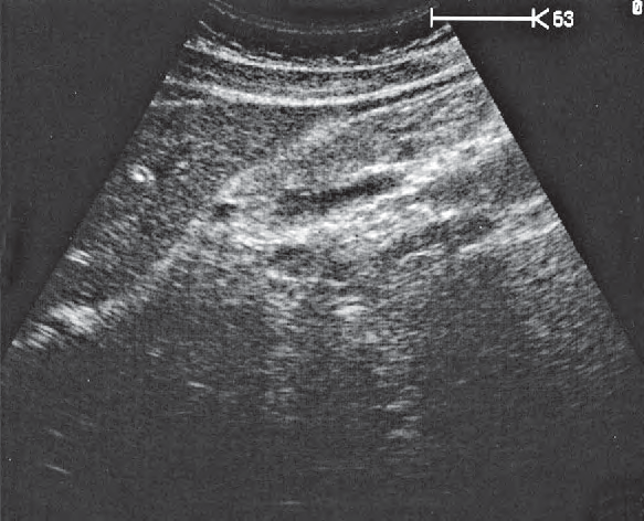 Stomach ultrasound image, Body of pancreas, splenic vein