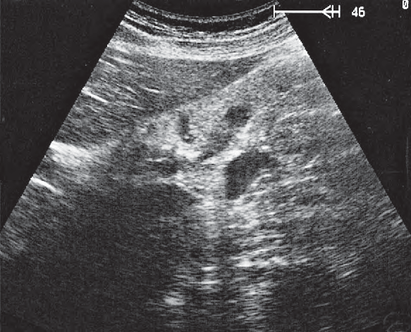 Tail of Pancreas Ultrasound Anatomy