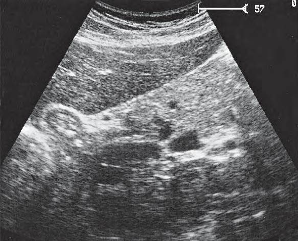 Left renal artery ultrasound image, Tail of pancreas, splenic artery and vein, renal artery and vein