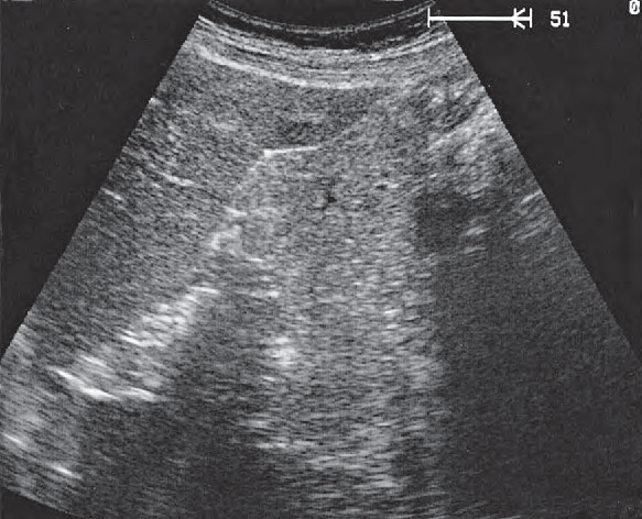 Left renal vein ultrasound image, Tail of pancreas