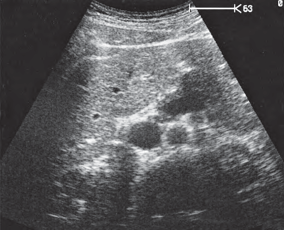 Quadrate lobe ultrasound image, Section cranial to head of pancreas, vena cava, splenic vein