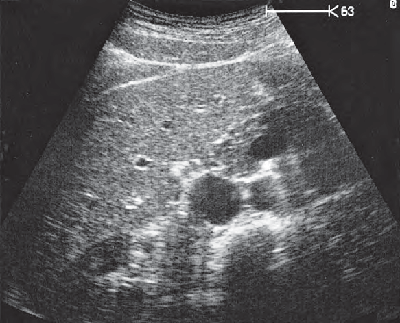 Uncinate process ultrasound image, Head of pancreas, vena cava, superior mesenteric vein