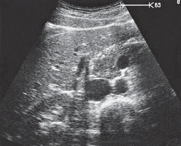 Gallbladder ultrasound image, Head of pancreas, vena cava, superior mesenteric vein, uncinate process, common bile duct