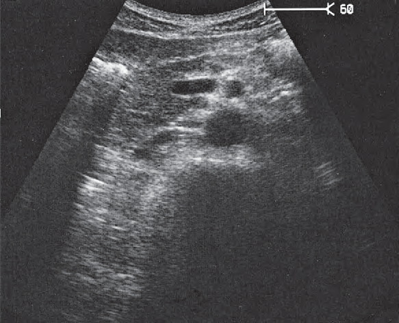 Duodenum ultrasound image, Infrarenal aorta and vena cava