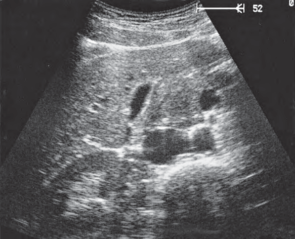 Gallbladder ultrasound image, Head of pancreas, vena cava, superior mesenteric vein, uncinate process, gallbladder