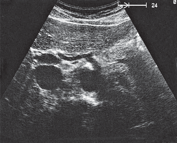 Stomach ultrasound image, Scan cranial to body of pancreas, celiac trunk