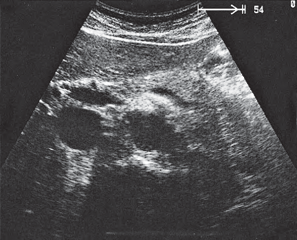 Stomach ultrasound image, Body of pancreas, splenic vein
