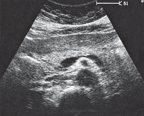 Uncinate process ultrasound image, Body of pancreas, splenic vein, superior mesenteric artery, aorta