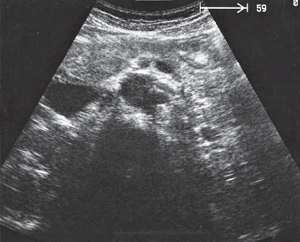 Left Renal Artery Ultrasound Anatomy