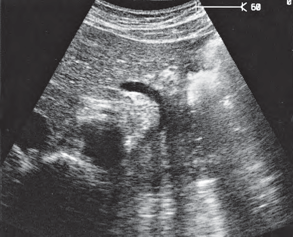 Artifact ultrasound image, Tail of pancreas, splenic artery