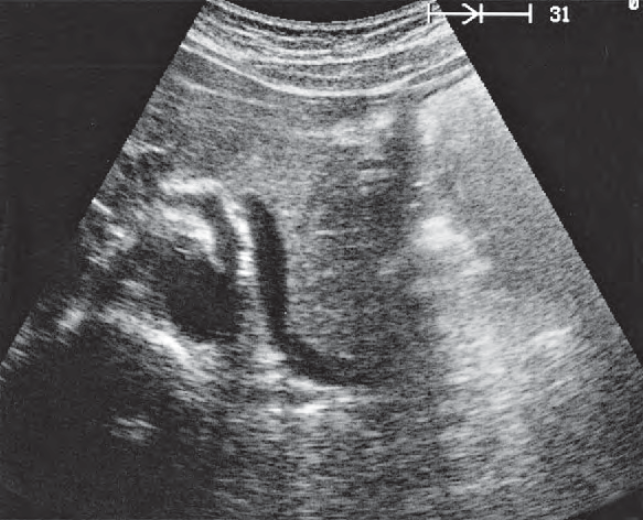 Artifact ultrasound image, Tail of pancreas, splenic vein