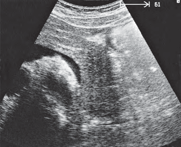 Stomach ultrasound image