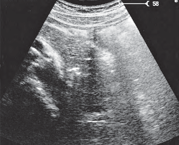 Stomach ultrasound image, Tail of pancreas
