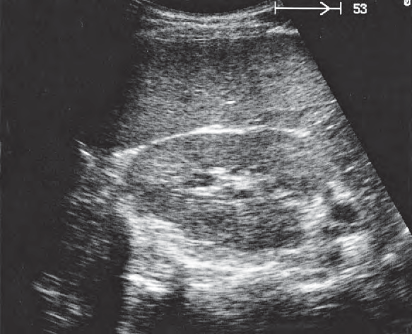 Spleen Ultrasound Anatomy