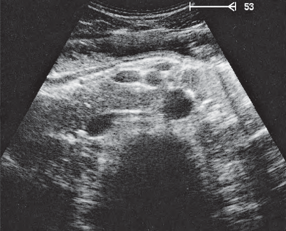 Superior mesenteric artery ultrasound image, Infrarenal aorta, vena cava, superior mesenteric artery and vein