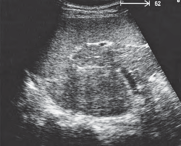 Spleen ultrasound image, Spleen, tail of pancreas, kidney