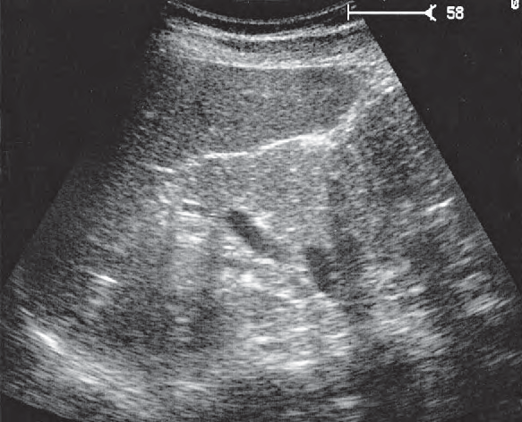 Left Colic Flexure Ultrasound Anatomy
