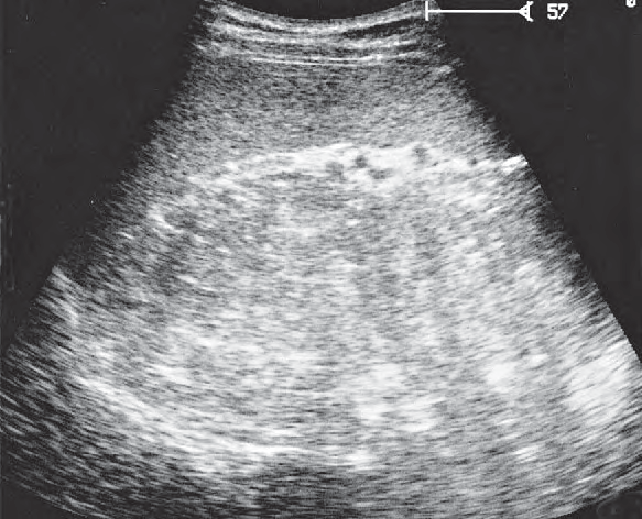Spleen ultrasound image, Scan anterior to tail of pancreas, spleen, stomach
