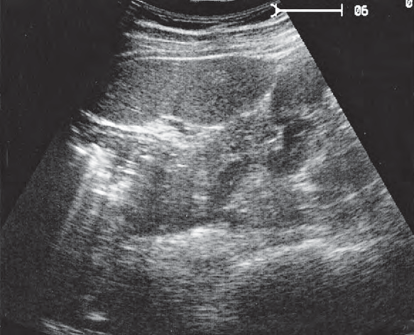 Spleen ultrasound image, Spleen, tail of pancreas, kidney