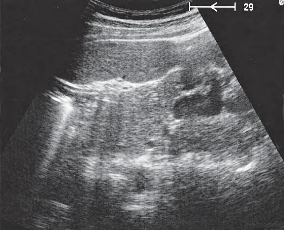 Stomach ultrasound image, Spleen, tail of pancreas, kidney