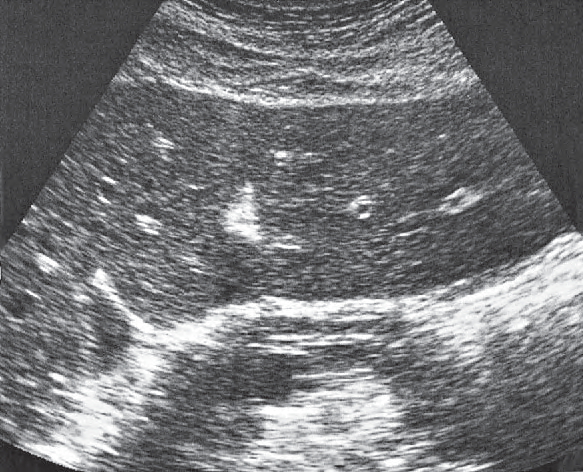 Pancreatic Duct Ultrasound Anatomy