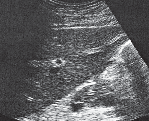 Stomach ultrasound image, Longitudinal scan of pancreatic duct