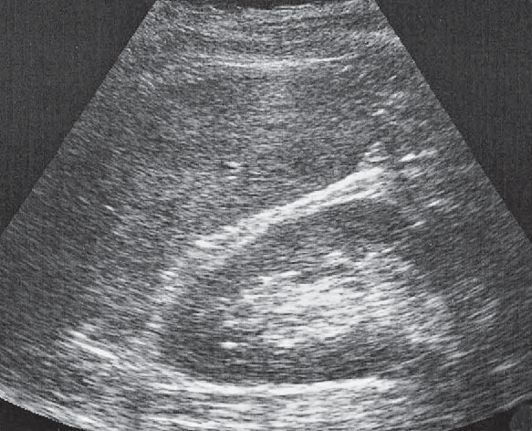 Spleen ultrasound image, Spleen, kidney
