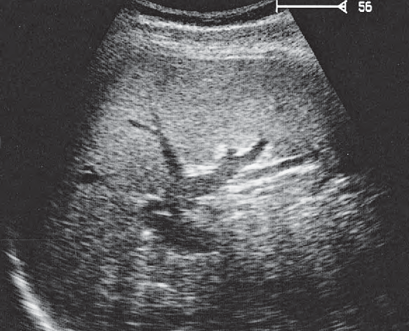 Spleen ultrasound image, Splenic hilum, splenic vein