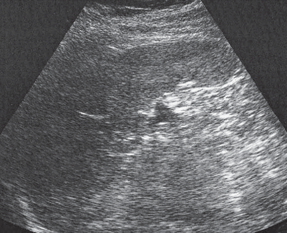 Spleen ultrasound image, Spleen, stomach