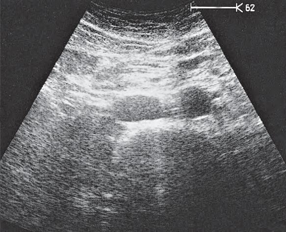 Spinal column ultrasound image, Infrarenal aorta and vena cava