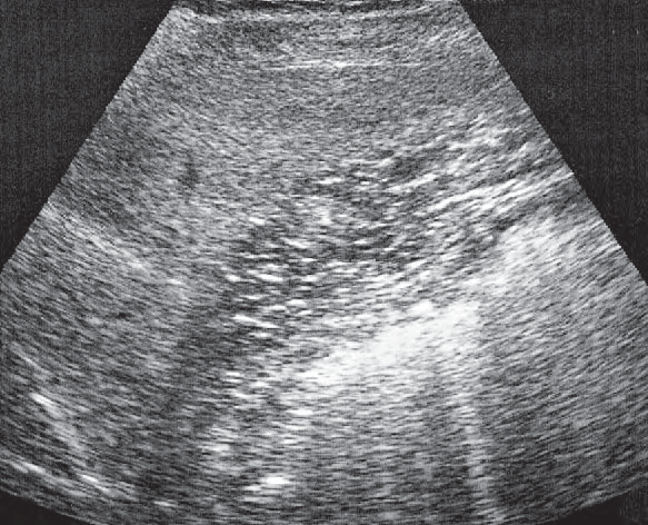 Spleen ultrasound image, Spleen, stomach
