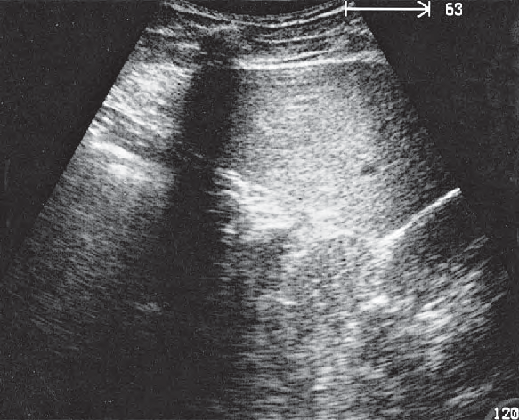 Spleen ultrasound image, Spleen, kidney, stomach