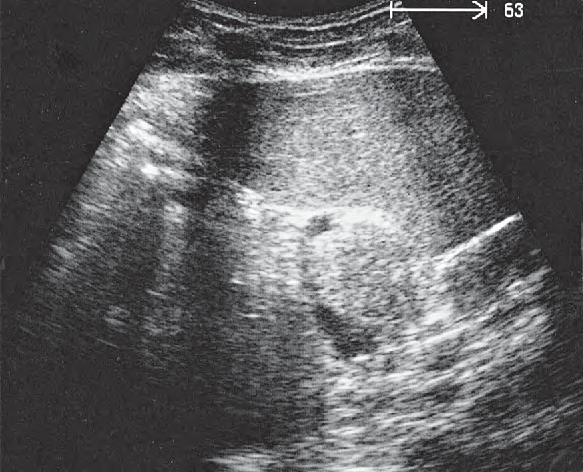 Spleen ultrasound image, Spleen, kidney, pancreas