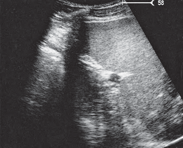 Spleen ultrasound image, Spleen, stomach