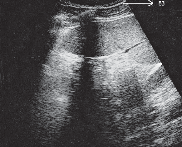 Small Bowel Ultrasound Anatomy