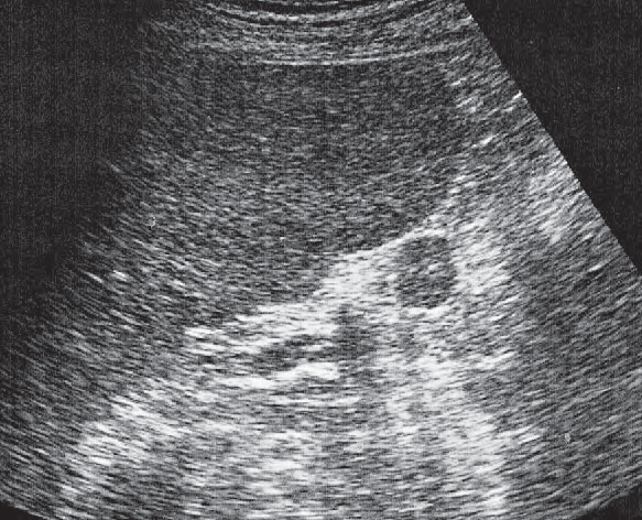 Accessory Spleen Ultrasound Anatomy