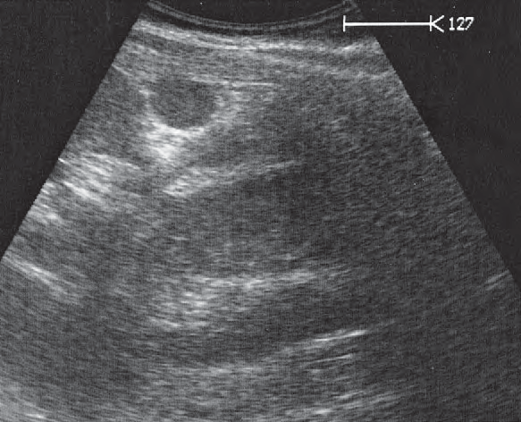 Spleen ultrasound image, Accessory spleen