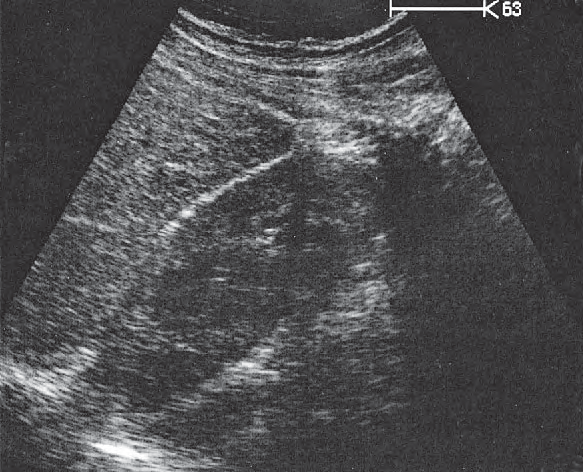 Right kidney ultrasound image, Kidney, liver