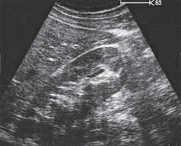 Right kidney ultrasound image, Kidney, liver, colic flexure