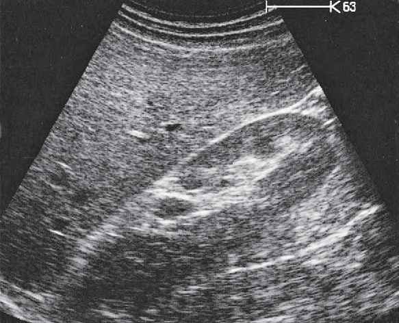 Right kidney ultrasound image, Kidney, renal vein, liver