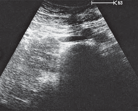 Iliac Artery Ultrasound Anatomy