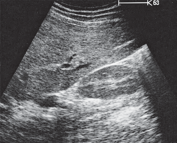 Right kidney ultrasound image, Kidney, renal vein, liver