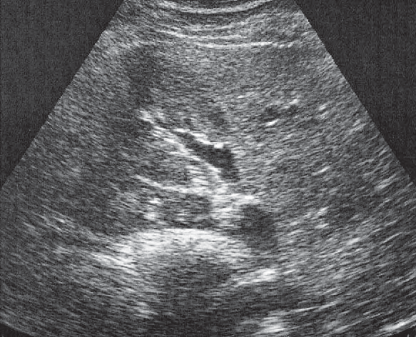 Psoas Muscle Ultrasound Anatomy