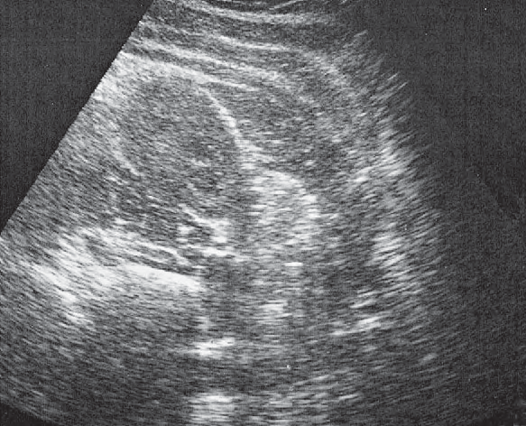 Right kidney ultrasound image, Kidney, liver, psoas muscle, quadratus lumborum muscle