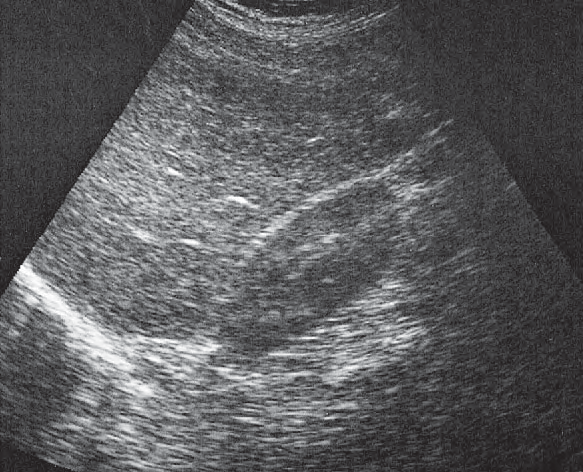 Right kidney ultrasound image, Kidney, liver