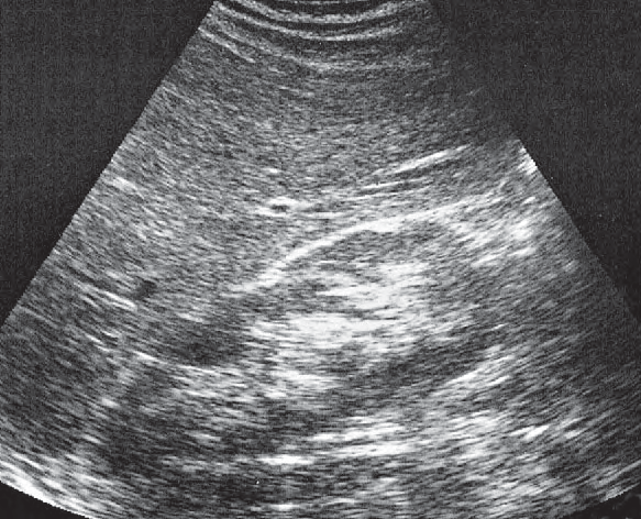 Right kidney ultrasound image, Kidney, liver, colic flexure