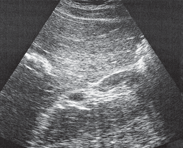 Right kidney ultrasound image, Kidney, renal vein, colon